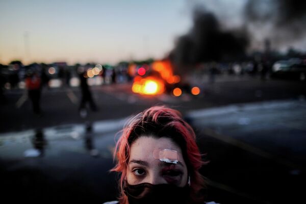 Девушка с травмами, полученными во время протестов в Миннеаполисе Девушка с травмами, полученными во время протестов в Миннеаполисе