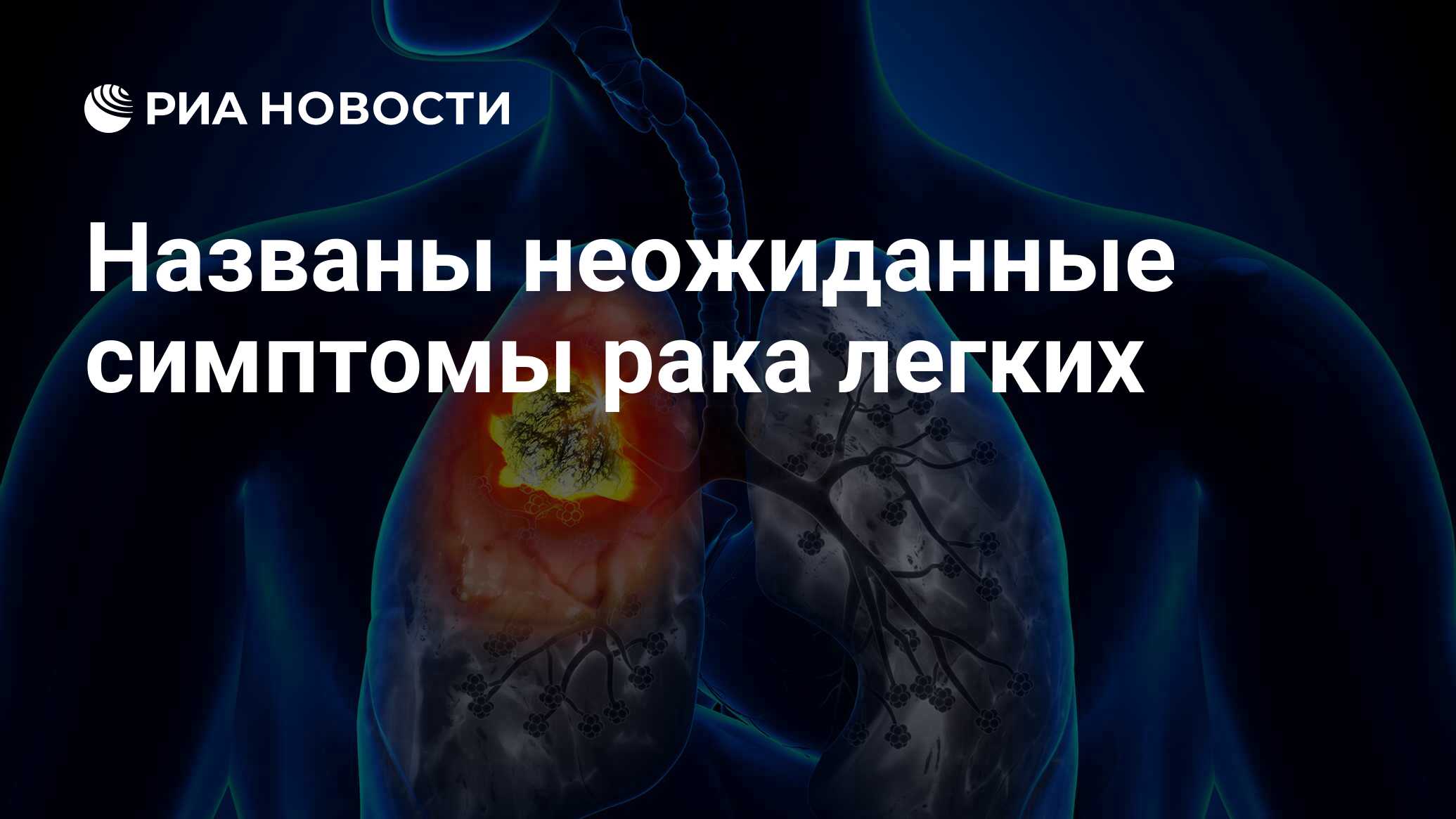 Кто выжил после рака легких